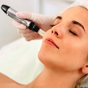 micro needling microneedling